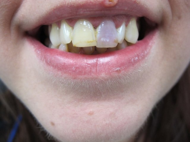 Internal Bleaching Before